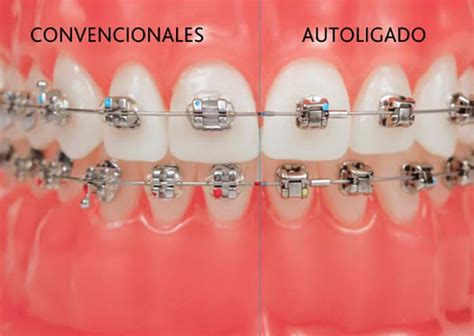 ortodoncia brackets metalicos y consulta gratis|brackets convencionales vs autoligado.